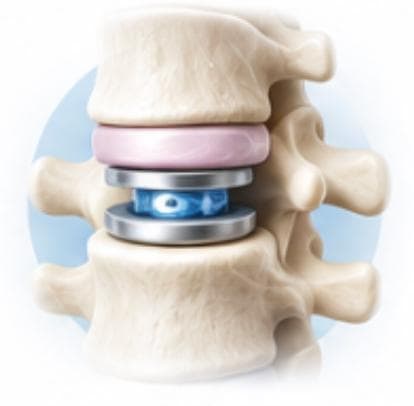 Disc Replacement Surgery