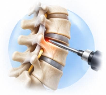 Endoscopic Spine Surgery