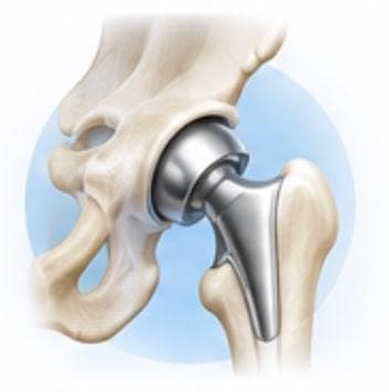 Hip Replacement Surgery