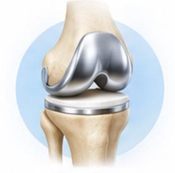 Knee Replacement Surgery