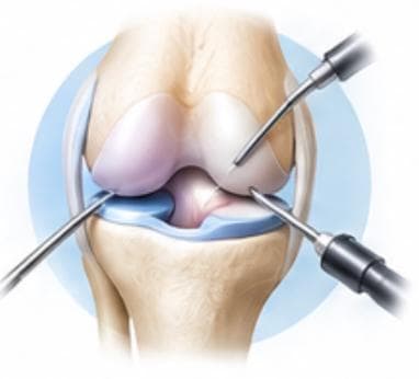 Arthroscopy Surgery