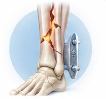 Fracture & Trauma Care