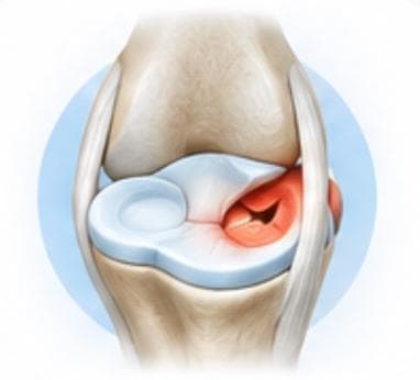 Meniscus Tear Treatment