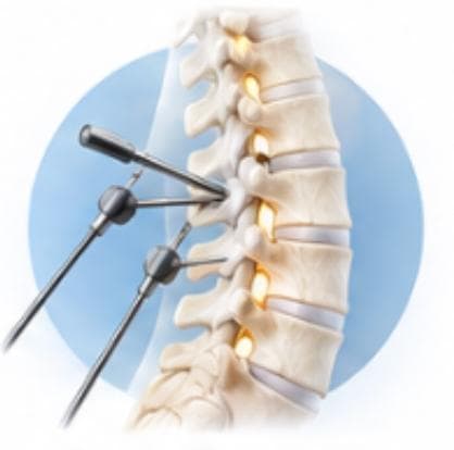 Minimally Invasive Spine Surgery (MISS)