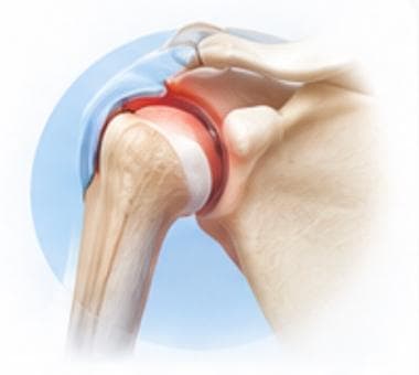 Shoulder Dislocation Treatment, performed by Dr. Nirmal Patil, MS (Ortho)